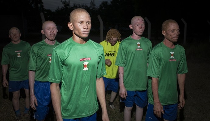 Белый шоколад. Как «Реал» и «Барселона» помогают африканским футболистам-альбиносам