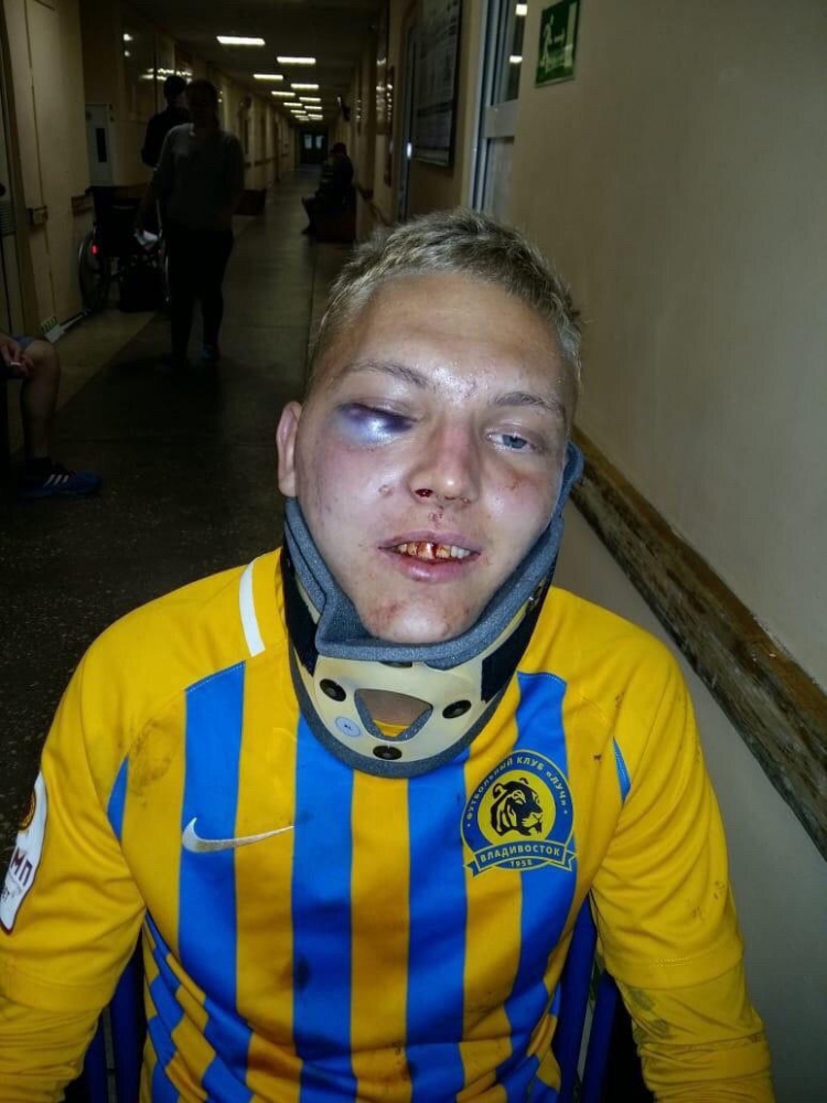 Футболист «Луча» сломал челюсть во время матча. Фото
